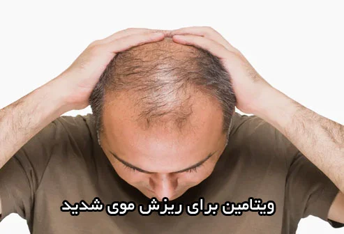 ویتامین برای ریزش موی شدید