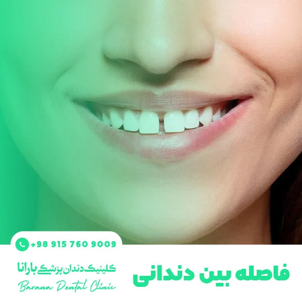 بستن فاصله دندان با کامپوزیت