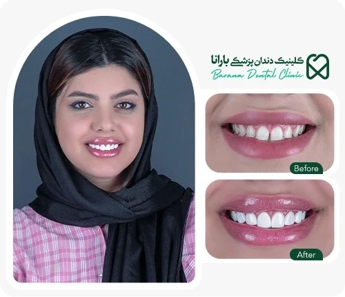 بستن فاصله دندان با کامپوزیت