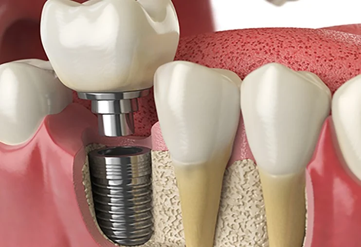 بررسی کتب تخصصی ایمپلنت و پروتزهای دندانی